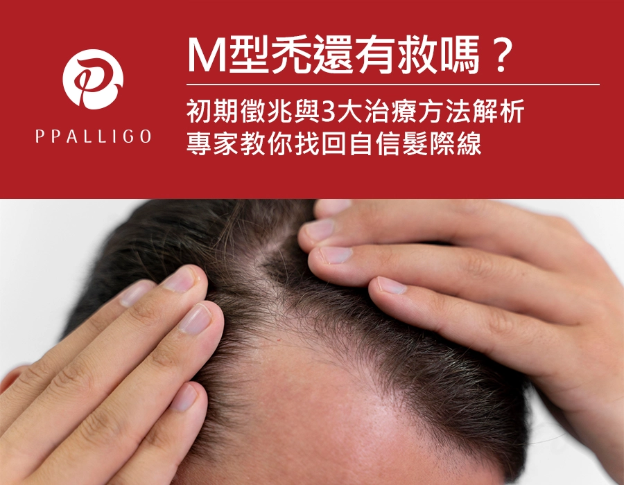 M型禿還有救嗎?初期徵兆與3大治療方法解析,專家教你找回自信髮際線